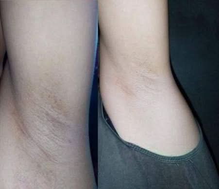 Meladerm