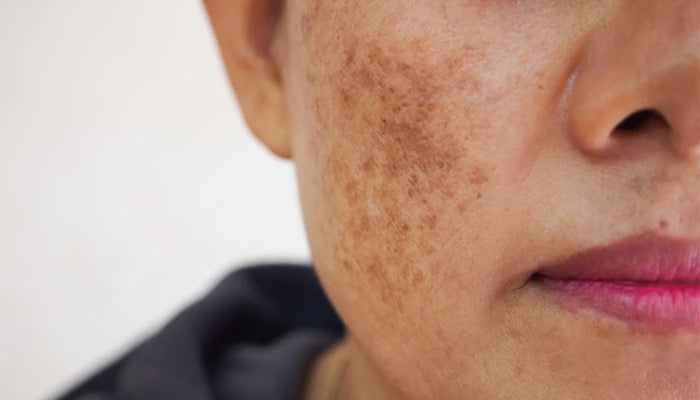 What is Hyperpigmentation? Treatment, types and causes
